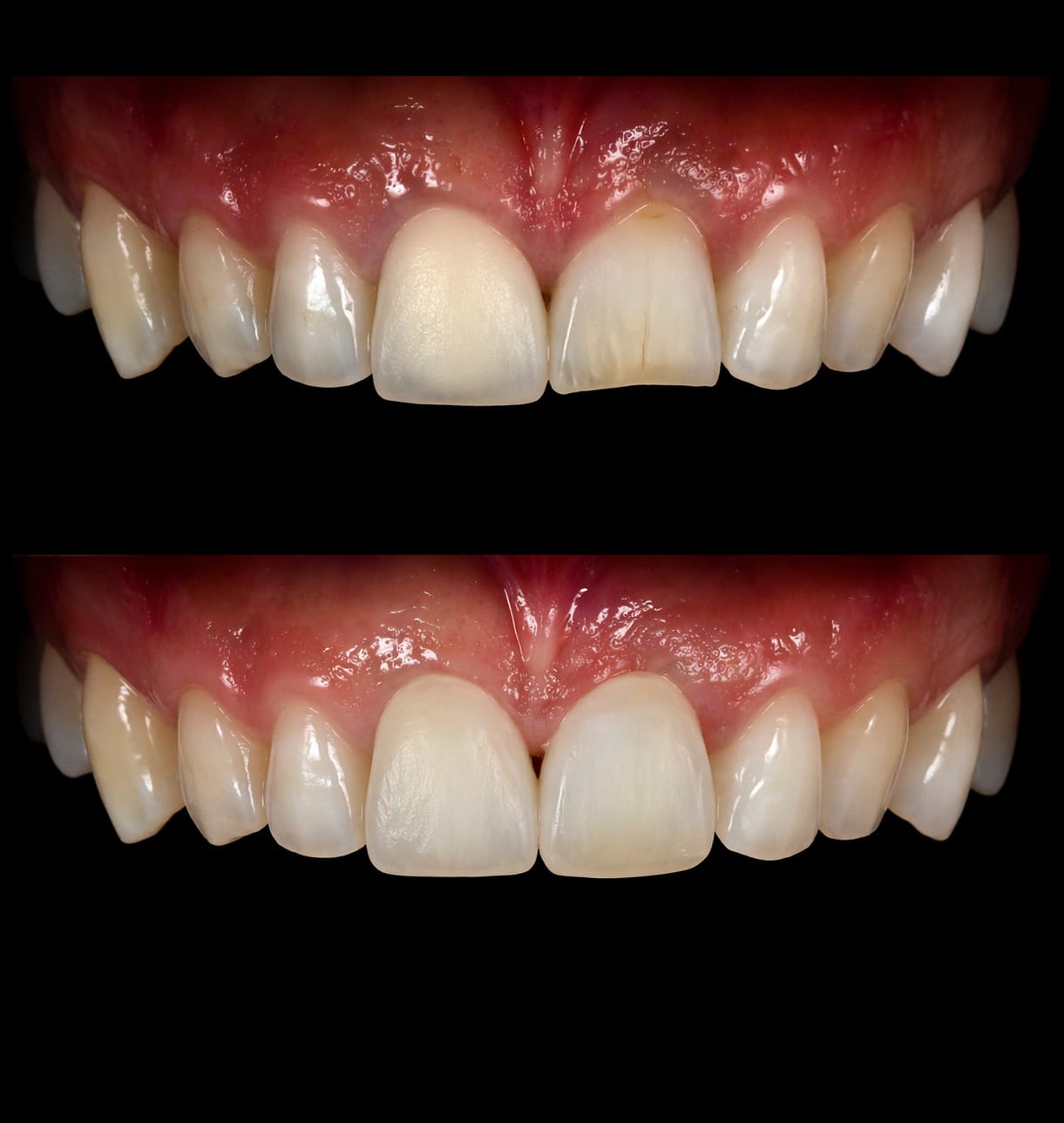 Caso clínico — Restaurações estéticas em resina nos dentes anteriores