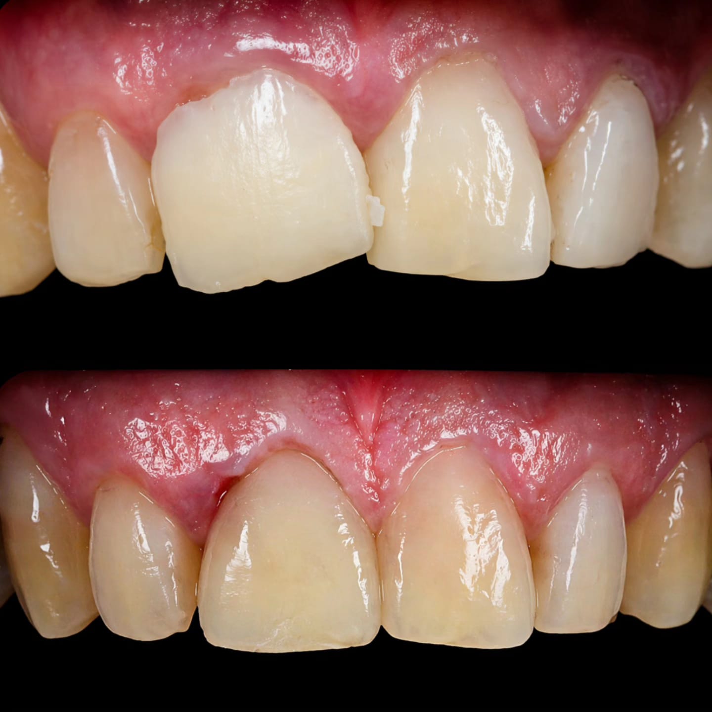 Caso clínico — Harmonização gengival e reanatomização dental