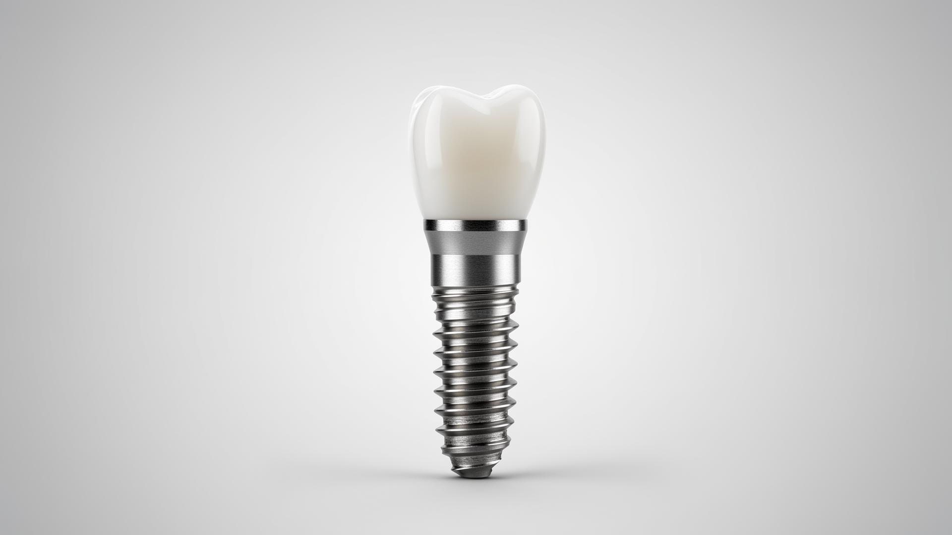Implantes Dentários